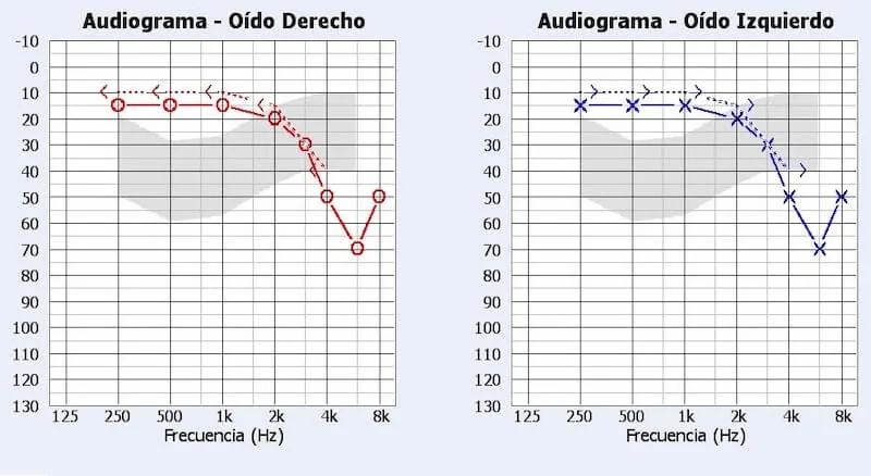 audiograma trauma acústico